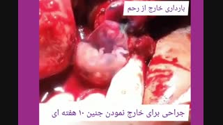 حاملگی خارج از رحم و جراحی برای خارج کردن جنین 10 هفته ای
