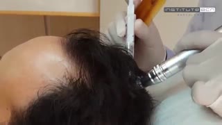 آموزش آیا مزوتراپی برای رشد مو کارایی دارد- مومیس مشاور و  مرجع تخصصی مو