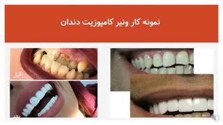 تخفیف ونیر کامپوزیت دندان