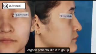 خانم های افغان  دوست دارند پشت بینی بالا بیاید