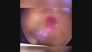 جراحی آندوسکوپی  هیدروسفالى