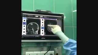 تومورهای نخاع (دکتر محسن القاسی) هایفوتراپی