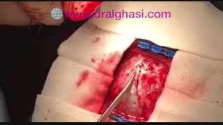 ضایعات عروقی مغز (دکتر محسن القاسی) میکرونیدلینگ