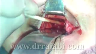 بازسازی شکستگی کاسه چشم با کارگذاری پروتز