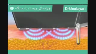 جوانسازی پوست با دستگاه RF