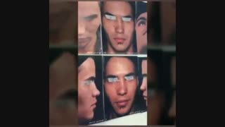 جراحی بینی زین اسبی با انحراف شدید