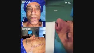 جراحی بینی مردانه