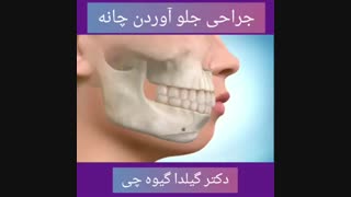 جراحی جلو آوردن چانه ترمیم ونیر