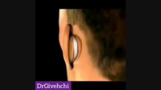 روند جراحی زیبایی گوش