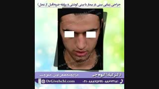 عمل جراحی شکستگی بینی گوشتی