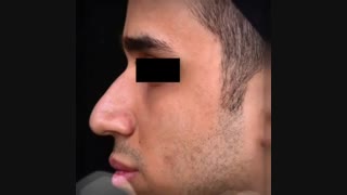 نمونه عمل جراحی بینی