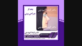 قبل و بعد از جراحی زیبایی بینی
