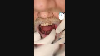 درمان فول ایمپلنت فک پایین در آقای ۵۹ ساله توسط دکتر شهریار جنانی