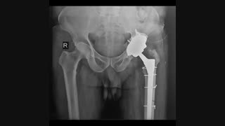 مثال هایی از جراحی مجدد تعویض مفصل ران