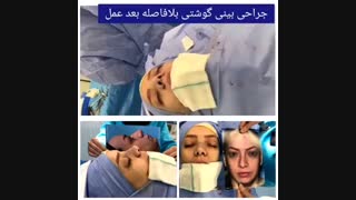 فیلم جراحی بینی گوشتی