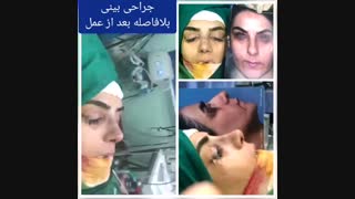 نتیجه جراحی بینی گوشتی