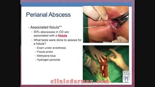 آیا تفاوت فیستول و آبسه مقعدی تنها در روش‌های درمان آنهاست؟ - پایتخت