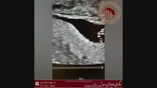 فیلم سونوگرافی جنین غیر نرمال