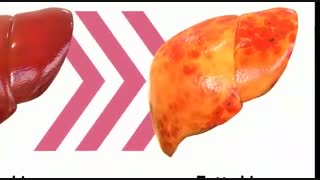 فیبرواسکن در کبد چرب