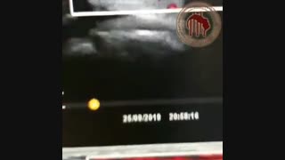 فیلم سونوگرافی ندول تیروئید