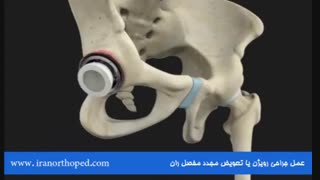 رویژن یا جراحی مجدد مفصل ران