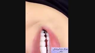 تفاوت لمینیت سرامیکی با ونیر کامپوزیت | مزایای لمینیت سرامیکی | مزایای ونیر کامپوزیت | لمینیت کردن دندان بدون تراش