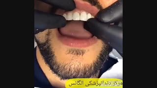 مدت ماندگاری لمینیت دندان | کامپوزیت دندان اروپایی | تفاوت کامپوزیت دندان با روکش دندان | فیلم لمینیت کردن دندان