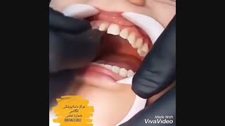 مراحل بیلیچینگ دندان | بریج دندان | انواع ونیر کامپوزیت | طریقه اصلاح طرح لبخند | بهترین متخصص اصلاح طرح لبخند