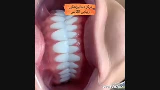 مزایای لمینیت کردن دندان | معایب لمینیت کردن دندان | مزایا کامپوزیت کردن دندان | معایب کامپوزیت دندان