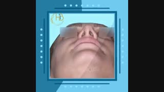 فیلم عمل ترمیم بینی