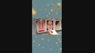 نمونه جراحی رینوپلاستی دکتر هیربد بهنام
