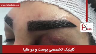 کاشت ابرو | فیلم کاشت ابرو | کلینیک پوست و مو هلیا | شماره 28