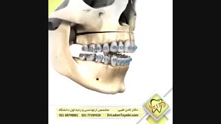 درمان اپن بایت با جراحی فک | دکتر لادن طیبی