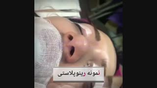 جراحی زیبایی بینی برداشتن خال