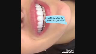 مزایای کامپوزیت دندان | معایب کامپوزیت کردن دندان | معایب لمینیت کردن دندان | ترمیم لمینیت دندان