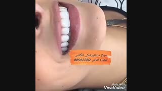 فیلم کامپوزیت کردن دندان | فیلم لمینت دندان | طریقه لمینت کردن دندان | فیلم اصلاح طرح لبخند | کاشت نگین دندان
