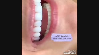 معروفترین دندانپزشک کودکان | مراحل کاشت نگین دندان | بریج دندان | طریقه اصلاح طرح لبخند | انواع روکش دندان