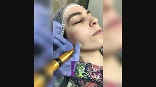 فیلم میکرونیدلینگ پلاستیک لثه