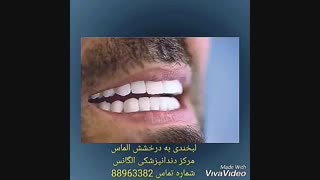 طریقه لمینیت کردن دندان | بهترین کلینیک دندانپزشکی مرکز تهران | بهترین کلینیک دندانپزشکی اطفال مرکز تهران