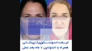 لیفت اندوسکوپی پیشانی