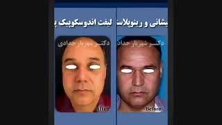 لیفت اندوسکوپیک پیشانی و رینوپلاستی