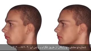 فیلم پروتز چانه دکتر پوست