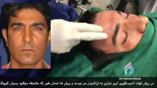 فیلم لیفت ابرو در حین جراحی