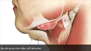 فیلم جراحی لیفت گردن