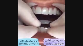 ویدیو لمینیت کردن دندان | مراحل کامپوزیت کردن دندان | بهترین دندانپزشک زیبایی | بهترین دندانپزشک ترمیمی