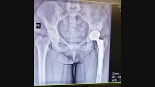 درمان دررفتگی مادرزاد مفصل لگن