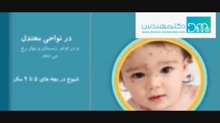 آبله مرغان چیست
