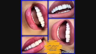 لمینیت کردن دندان بدون تراش دندان | کامپوزیت کردن دندان | قیمت روکش دندان | انواع روکش دندان
