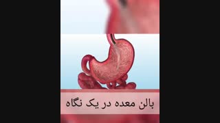 بالن معده در یک نگاه