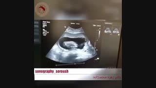 فیلم سونوگرافی جنین دوقلو